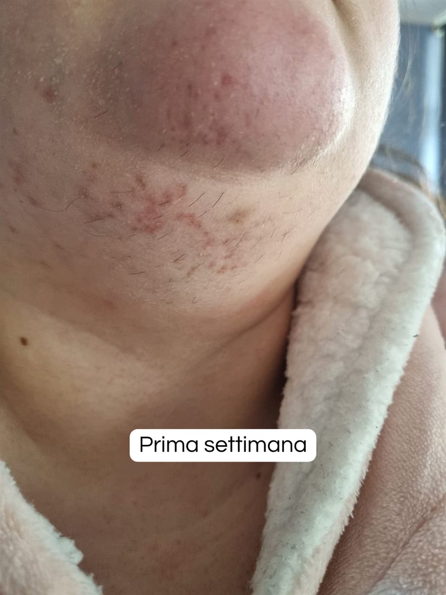 Zona del mento e del collo prima del trattamento