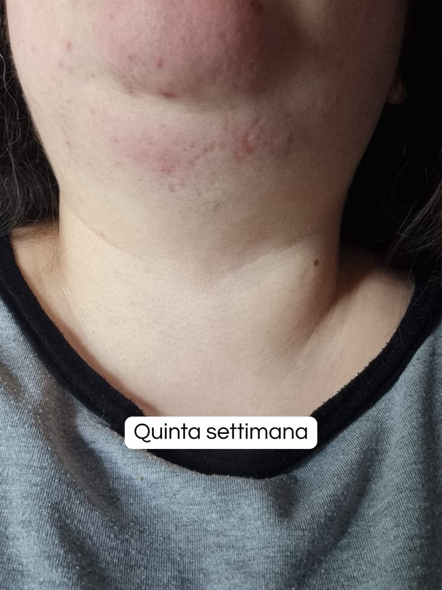 La stessa zona dopo cinque settimane di trattamento
