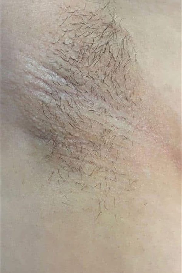 Ascella e gamba prima del trattamento con il CM Complex