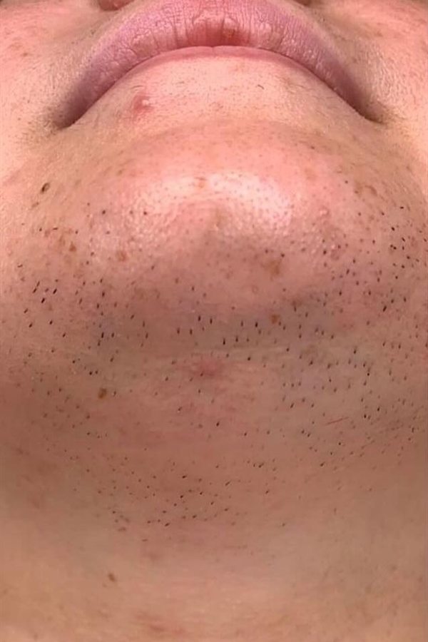 Mento e mascella prima del trattamento con il CM Complex