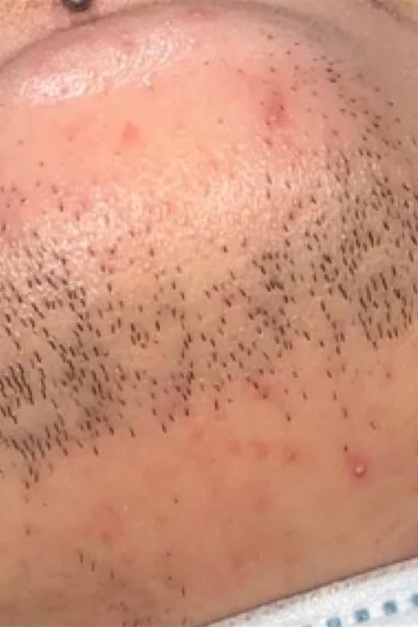 Mento e mascella prima del trattamento con il CM Complex