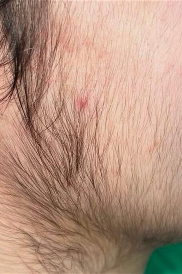 Mento e mascella prima del trattamento con il CM Complex