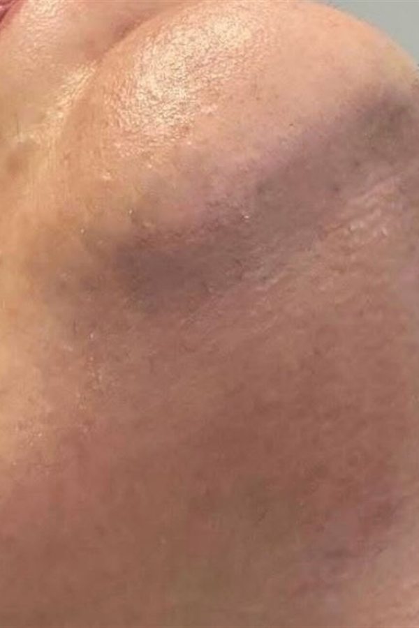 Mento e mascella prima del trattamento con il CM Complex