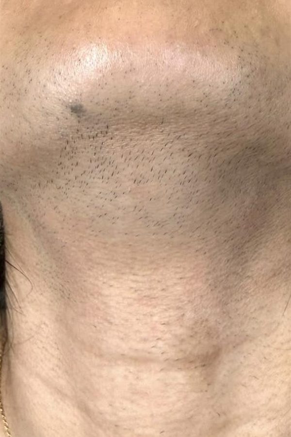 Mento e mascella prima del trattamento con il CM Complex