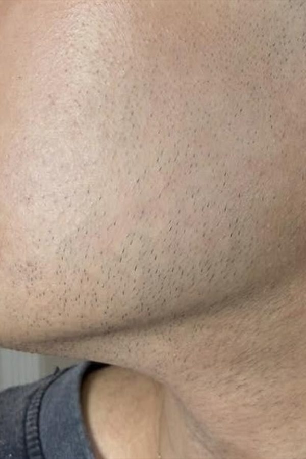 Mento e mascella prima del trattamento con il CM Complex