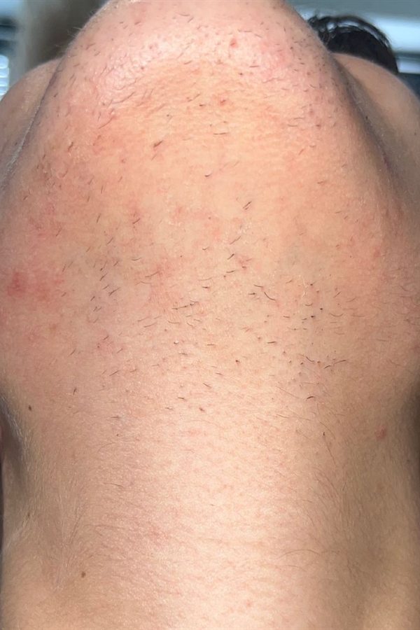 Mento e mascella prima del trattamento con il CM Complex